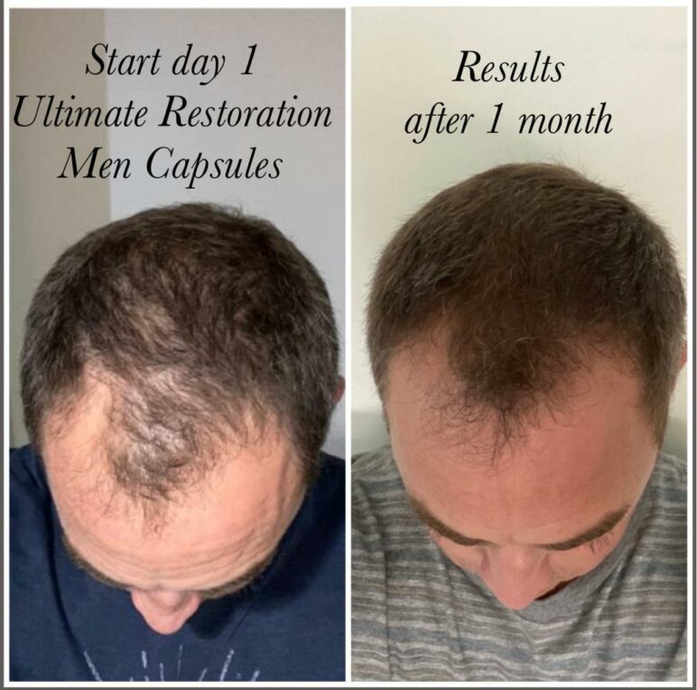 Ultimate Hair Restoration For Men